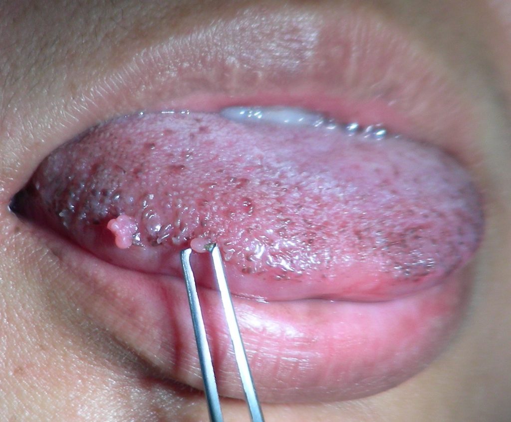 Wart in mouth