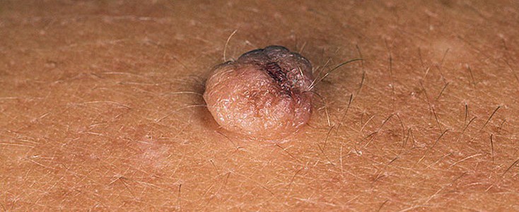 Genital wart