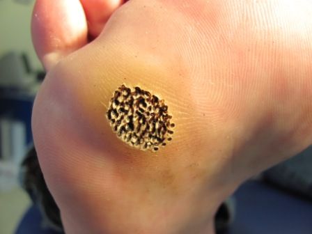 Plantar wart