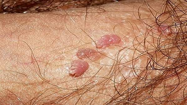 Genital warts in men