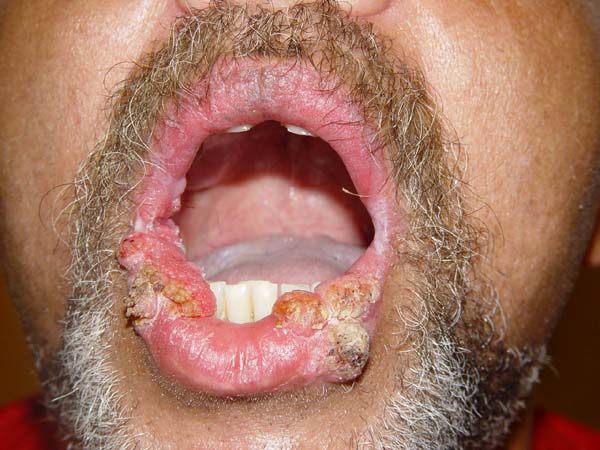 Genital warts on the lips