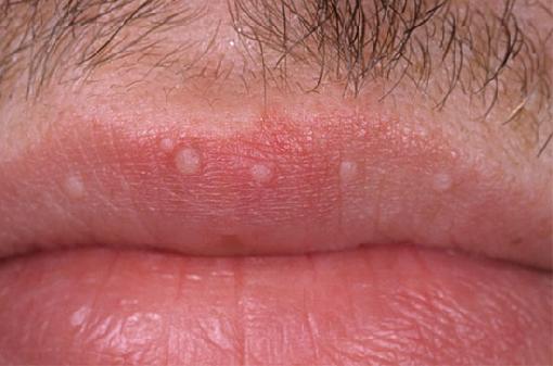 Lip warts caused by HPV
