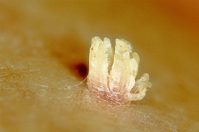 Threadlike wart