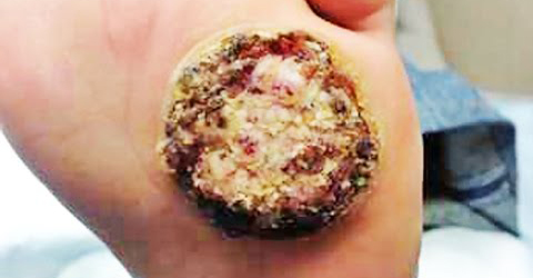 Untreated plantar wart