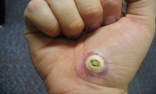 Wart on hand