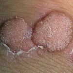 Wart