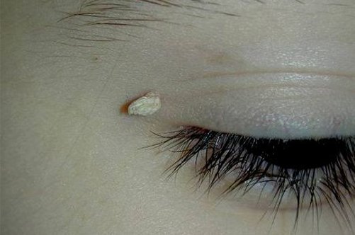 Warts on face