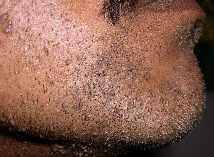 Filiform warts