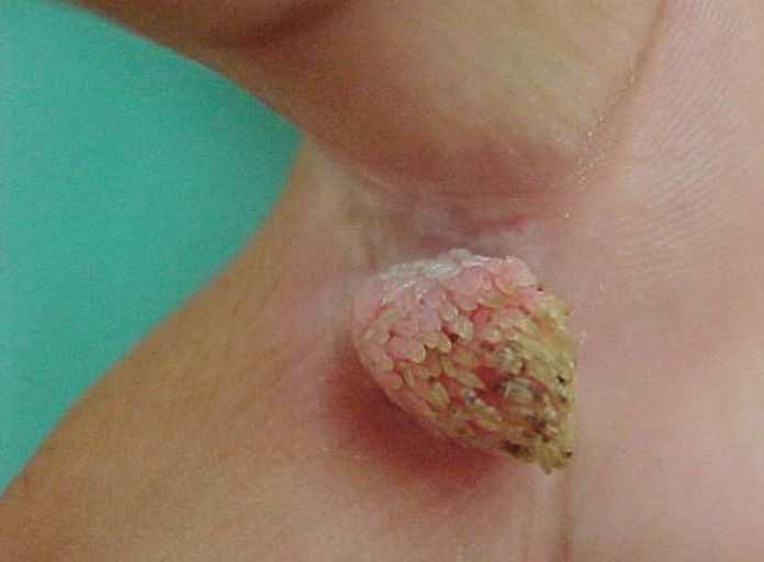 Filiform warts pictures