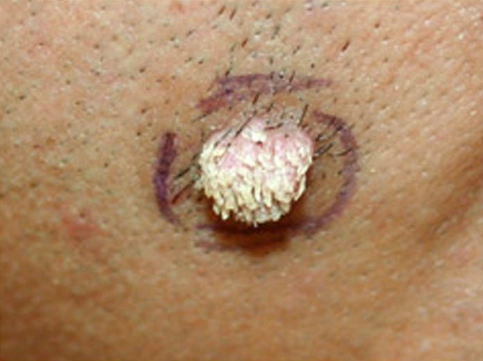 Filiform warts pictures