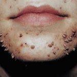 Filliform wart