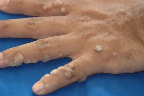 Warts on hand