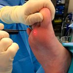 Laser surgery