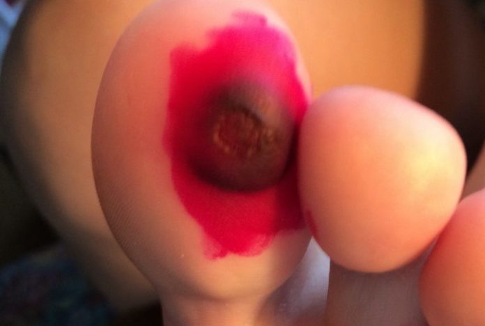 Plantar wart