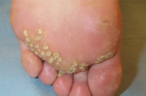 Plantar warts