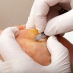 Surgical curettage
