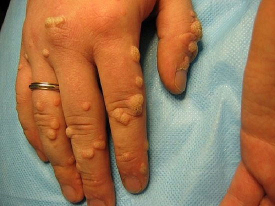 Warts on hands