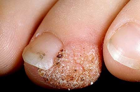 Wart on finger
