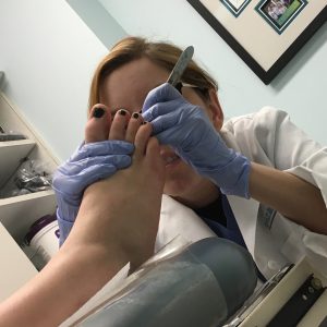 Wart removal doctor