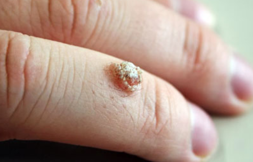Warts